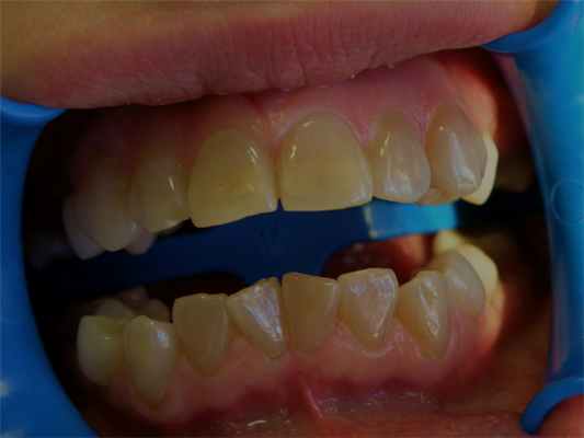 Рис. 1б. Зубы старшей сестры.