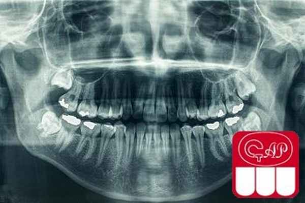 Дисплазия дентина