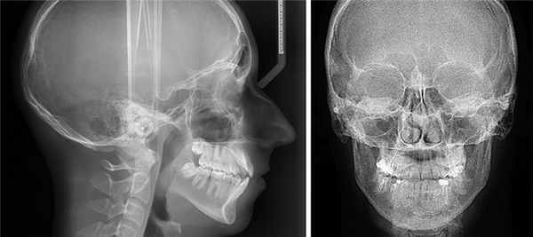 Рентген носовых пазух