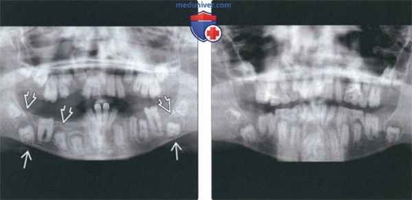 Рентгенограмма при несовершенном амелогенезе