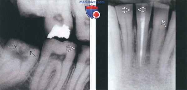 Рентгенограмма при несовершенном амелогенезе