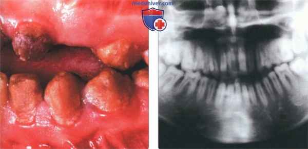 Рентгенограмма при несовершенном амелогенезе
