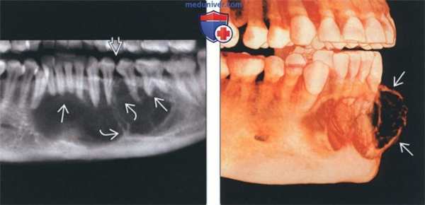 Лучевая диагностика одонтогенной миксомы челюсти