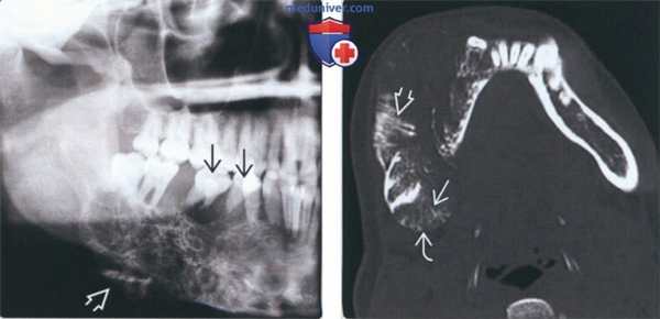 Лучевая диагностика одонтогенной миксомы челюсти