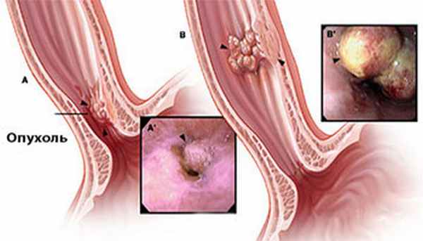 Лечение пищевода Баррета