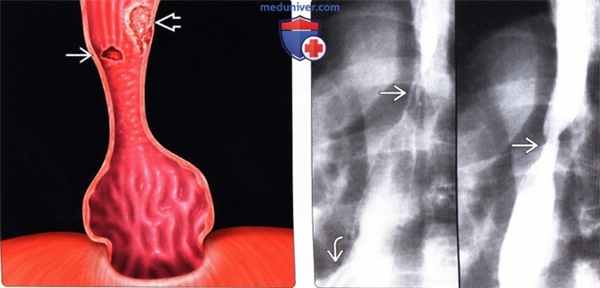 Лучевая диагностика пищевода Барретта
