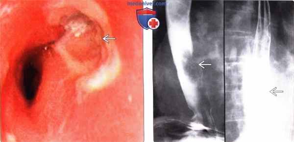 Лучевая диагностика пищевода Барретта