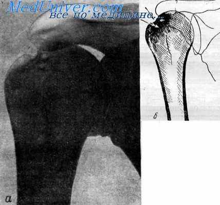 плече-лопаточный периартрит