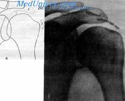 плече-лопаточный периартрит