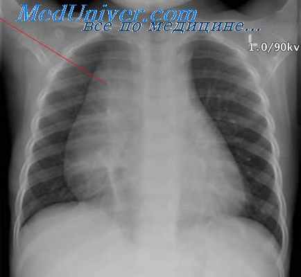 нейрогенные опухоли