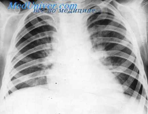 лимфогранулематоз