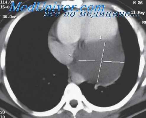 перикардиальные кисты