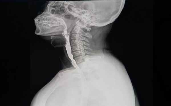 Снимок пищевода