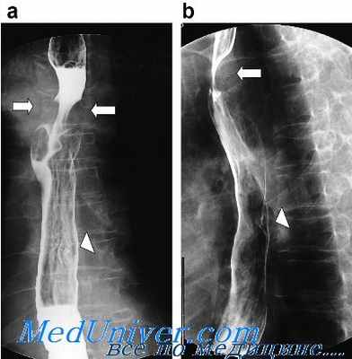 рентгенологическое исследование пищевода
