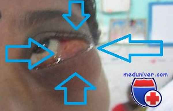 саркома глазницы