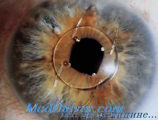 дислоцированные интраокулярные линзы