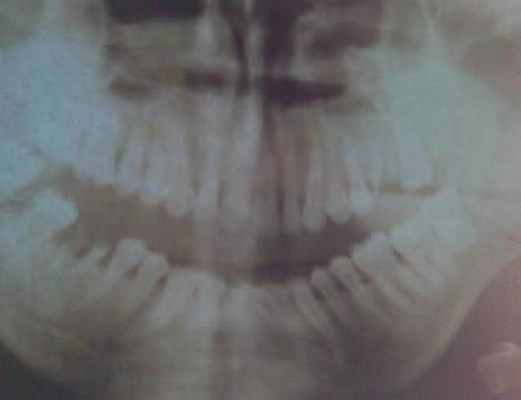 репозиция отломков челюстей