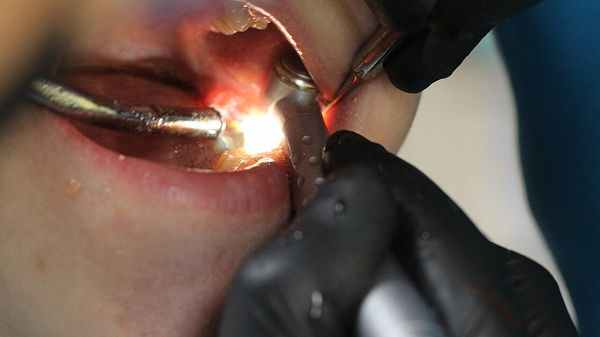 удаление ретинированного дистопированного зуба мудрости