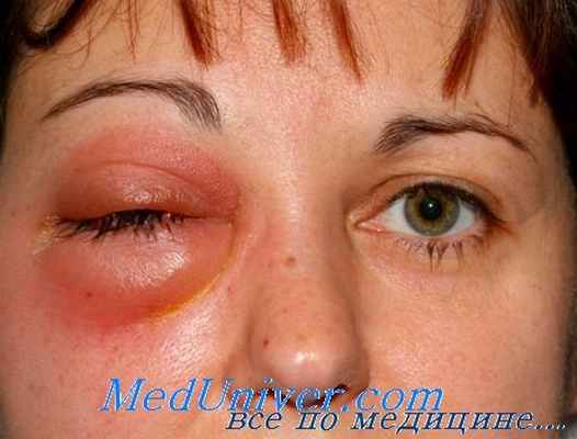 флегмона орбиты