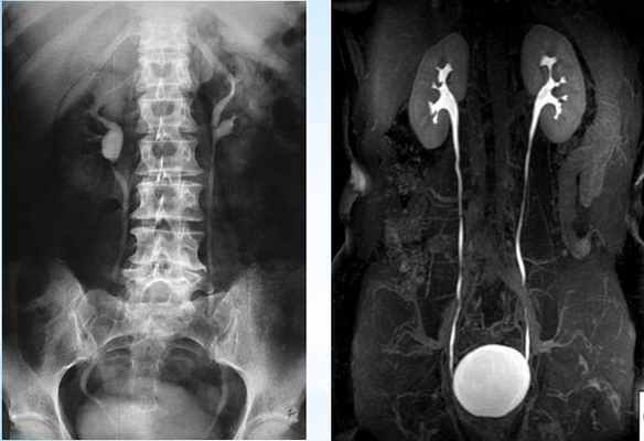 Пиелография перед оперативным вмешательством