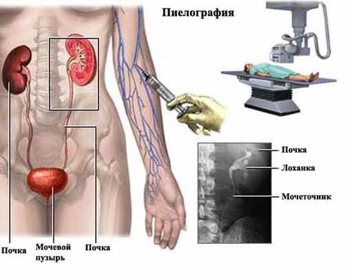 Рентгенография мочевыделительной системы