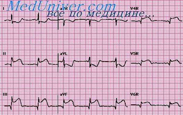инфаркт миокарда