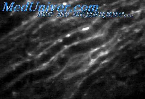 рецидивирующая астма