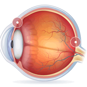 Поражение глаз