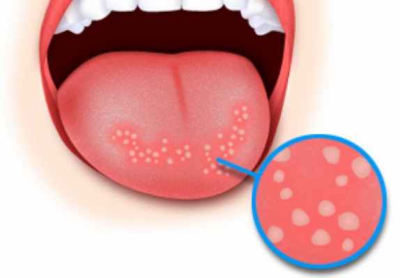 Хронический рецидивирующий афтозный стоматит