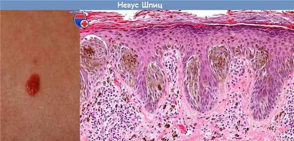 Невус Шпиц (Спитц)
