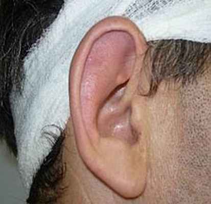 Рецидивирующий полихондрит