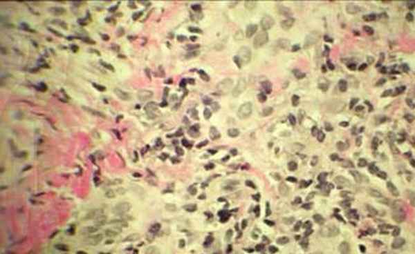 Рецидивирующий полихондрит