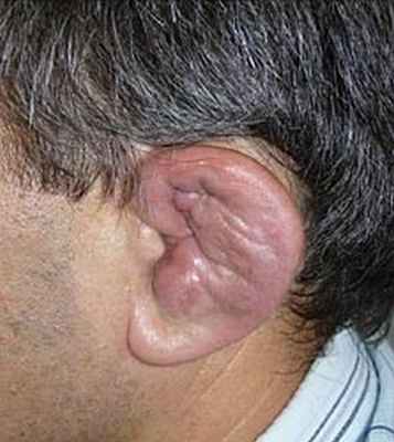 Рецидивирующий полихондрит