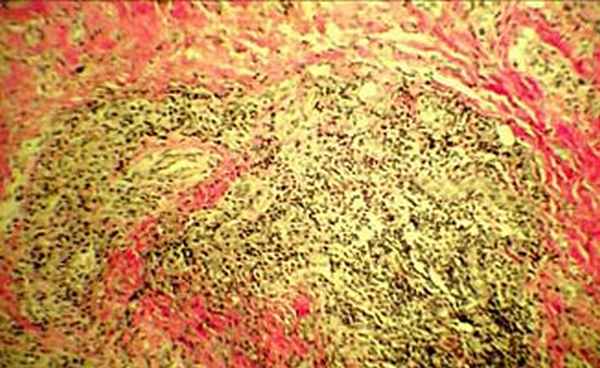 Рецидивирующий полихондрит