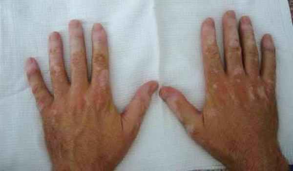 Рецидивирующий полихондрит