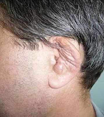 Рецидивирующий полихондрит