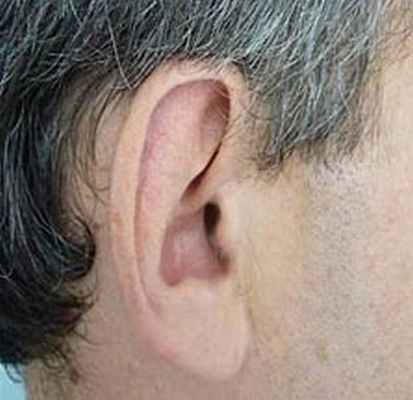 Рецидивирующий полихондрит