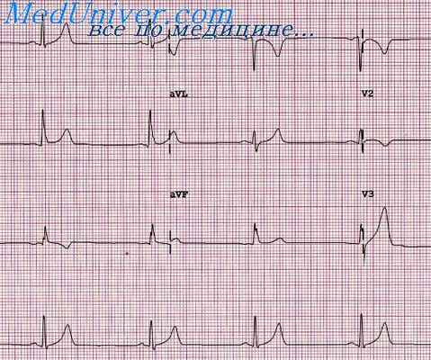 реципрокрная тахикардия