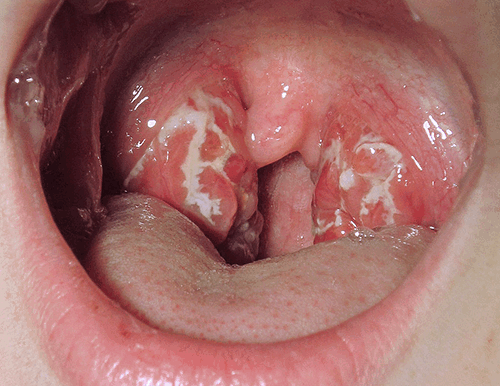 Стрептококковый фарингит