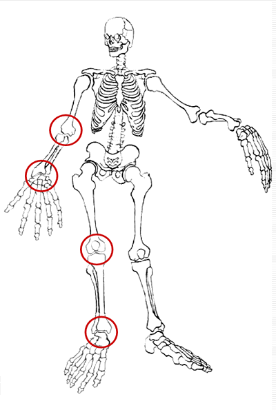 ревматический артрит
