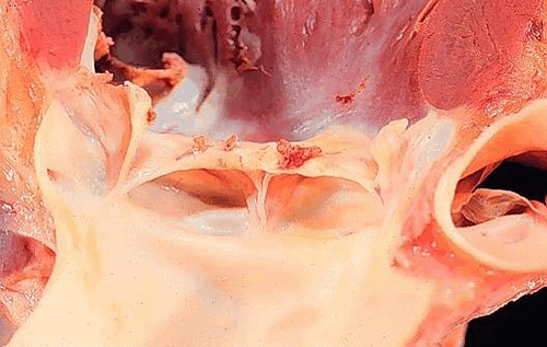 Ревматические вегетации на митральном клапане