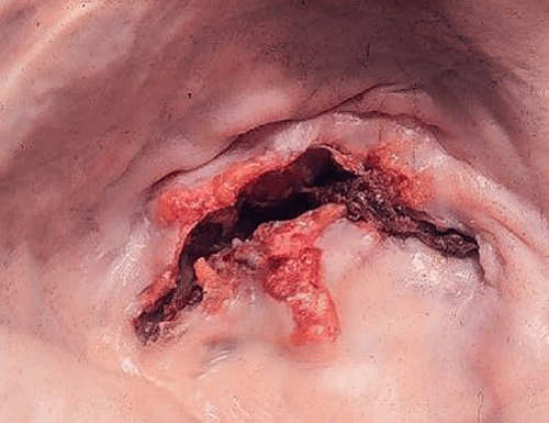 Ревматические вегетации на митральном клапане