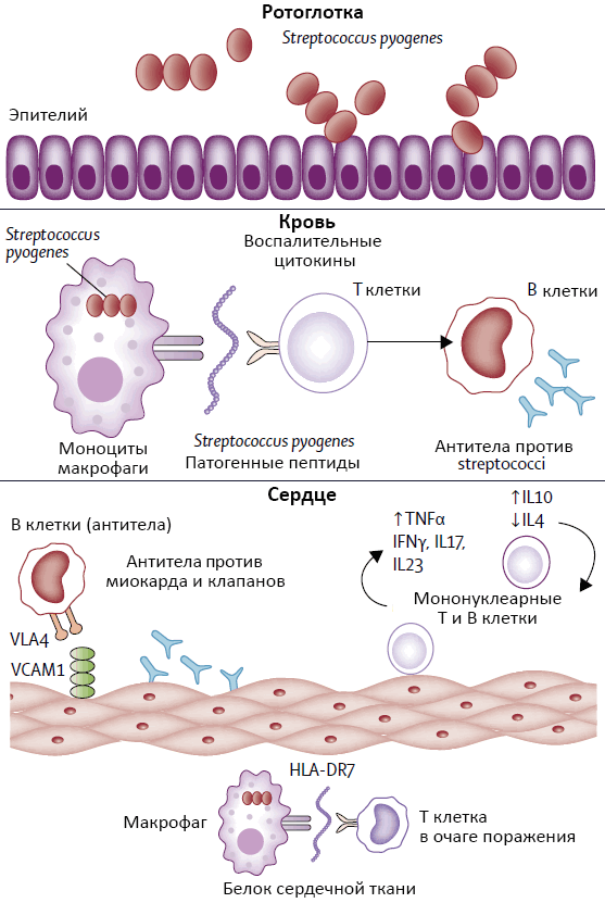Механизм поражения сердца при ревматической лихорадке