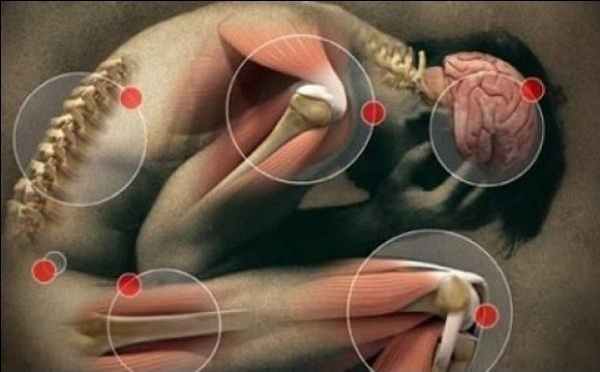 Острая ревматическая лихорадка