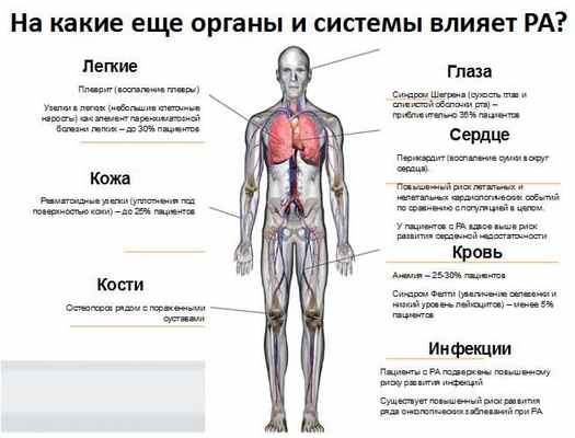 ревматоидный артрит.jpg