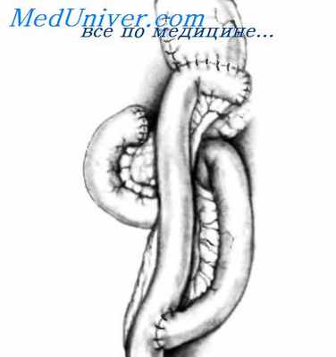 дренирующая операция