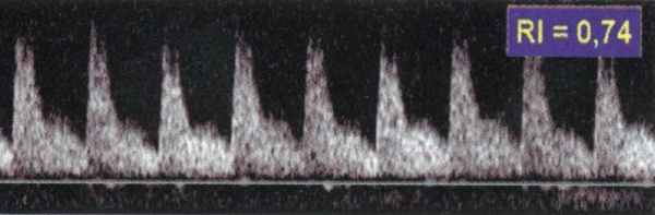 Эхографическая фаза 