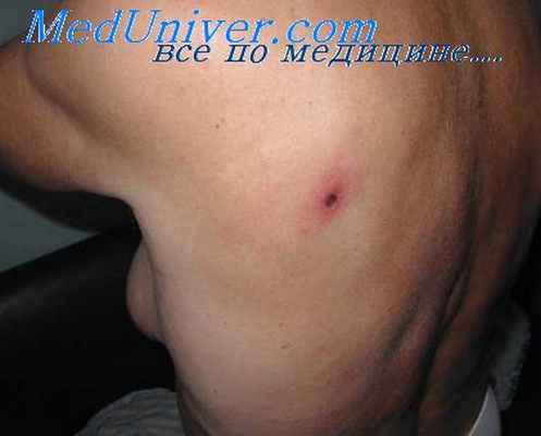 риккетсиозы