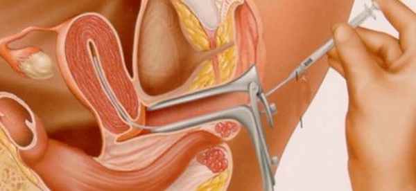 Внутриматочная инсеминация