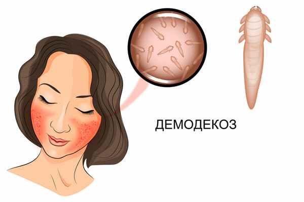 Демодекоз.jpg